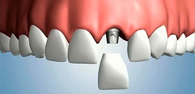 Имплантация переднего зуба