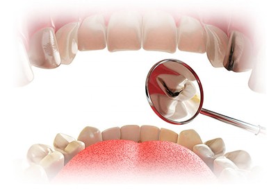 Средний кариес верхнего зуба