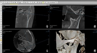 Компьютерная томография височно-нижнечелюстного сустава