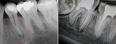 Обломок инструмента в зубном канале