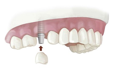 Протезирование одного зуба на имплантате