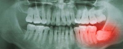 Ретенированный зуб