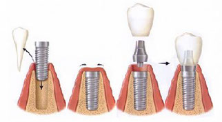 Имплантация жевательных зубов, костная пластика